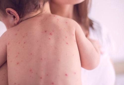 Улаанбурхан өвчний нийт батлагдсан тохиолдол 13 мянга боллоо