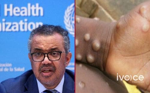 ДЭМБ сармагчны цэцэг өвчинтэй холбогдуулан олон улсын хэмжээнд онц байдал зарлав