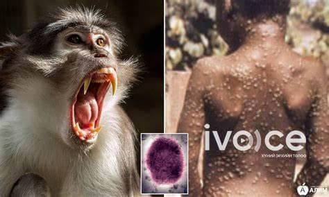 "Сармагчны цэцэг өвчин эрэгтэй хүн, эрэгтэй хүнтэй бэлгийн харьцаанд орох үед халдварлаж байна"